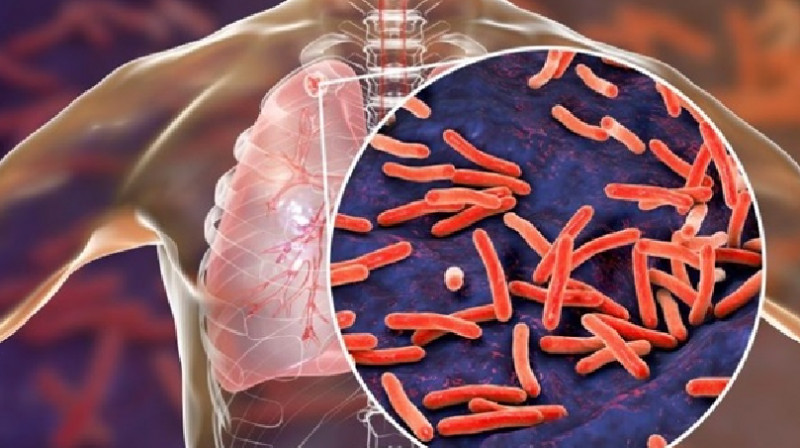 В Атырау у директора школы выявили туберкулез