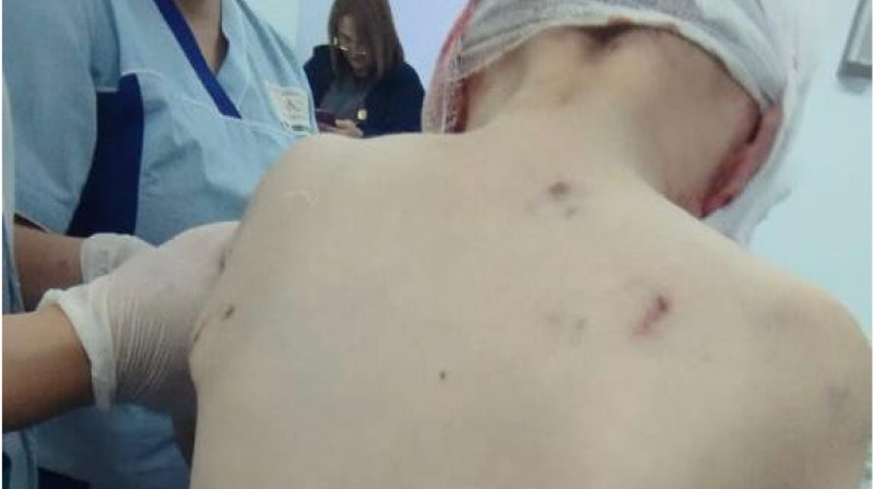 В Атырау ребенок попал в реанимацию из-за нападения собаки