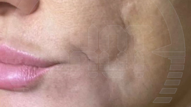 SMAS - лифтинг «сварил» лицо женщине в России