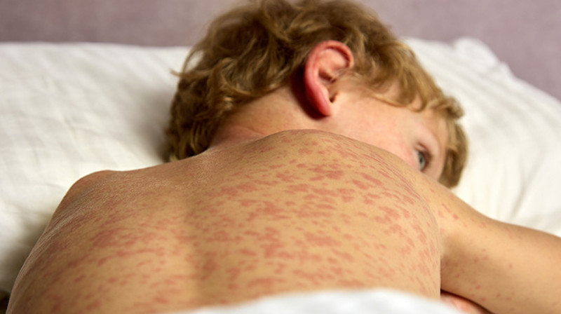 В Актобе эпидемия кори