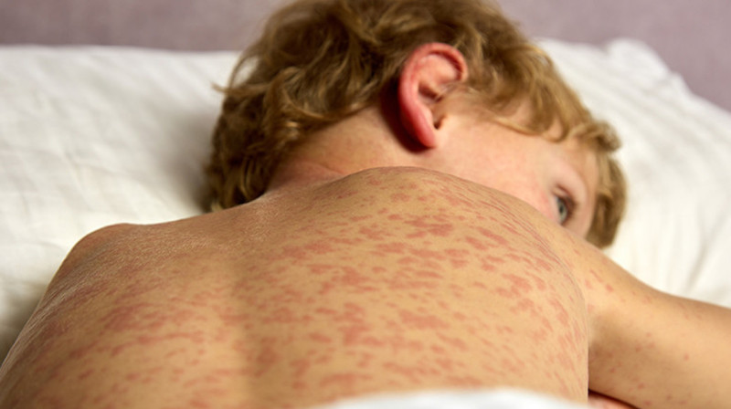 В Шымкенте наблюдается вспышка кори