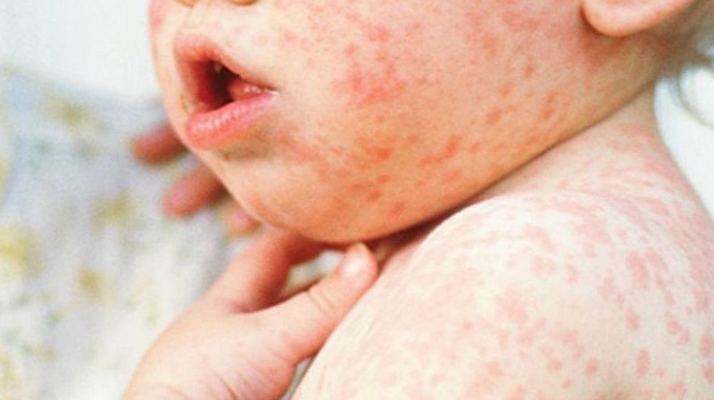 В столице начали массовую вакцинацию детей от кори