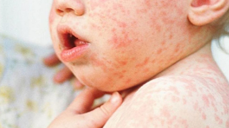 Число заболевших корью стремительно растет в ВКО