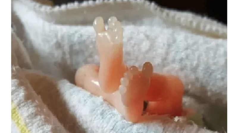 У жительницы Уральска после ЭКО развилась онкология