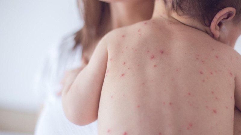 Около 200 детей получают лечение против  кори в столице