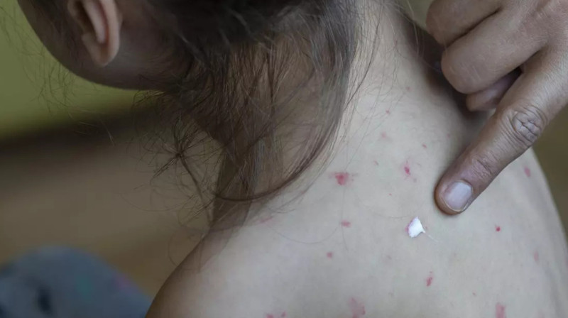 Последствия перенесённой кори могут быть смертельными - Минздрав