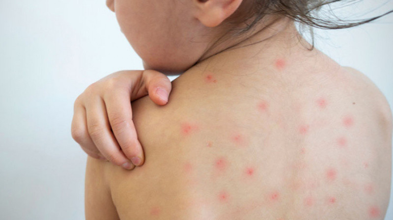 Более 20 тысяч случаев заболевания корью зарегистрированы в Казахстане