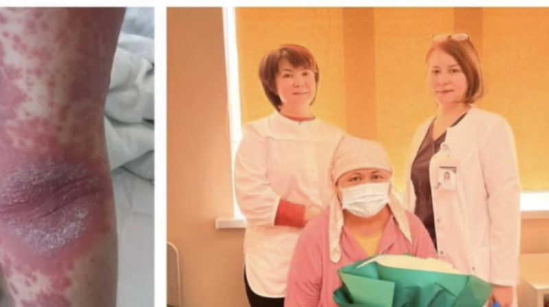 Использовала китайские мази: женщину с тяжелой формой аллергии спасли в Шымкенте