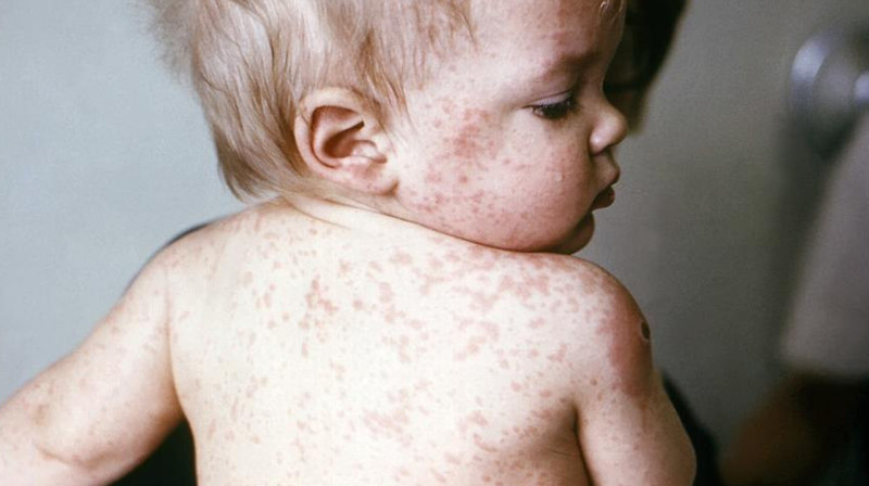 Казахстан возглавил список стран по распространенности кори