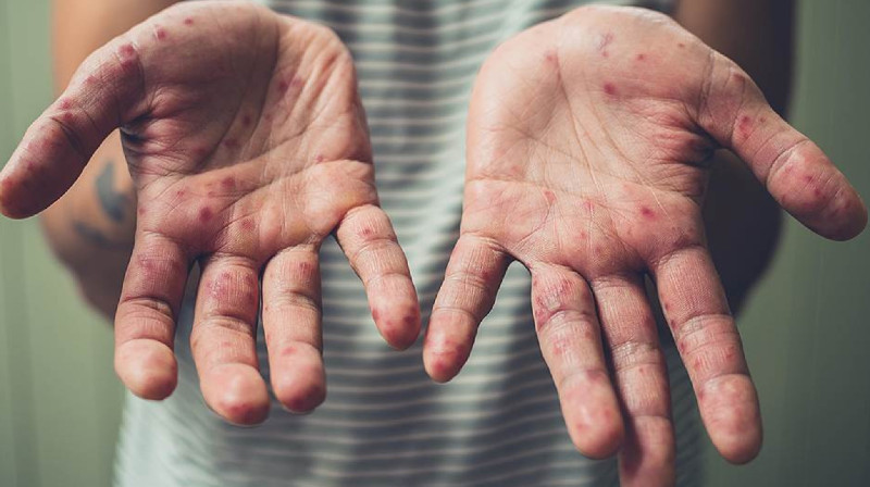 Вспышка кори в Казахстане стала крупнейшей за последние 30 лет