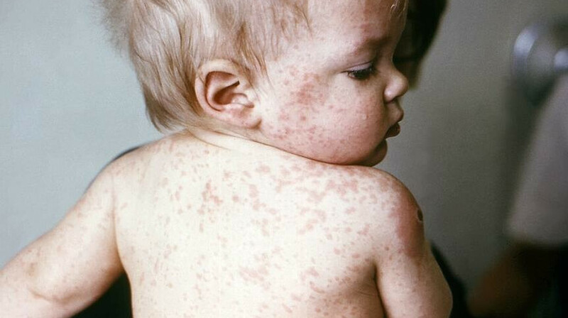 Эпидемия кори: санврачи обратились к жителям ВКО