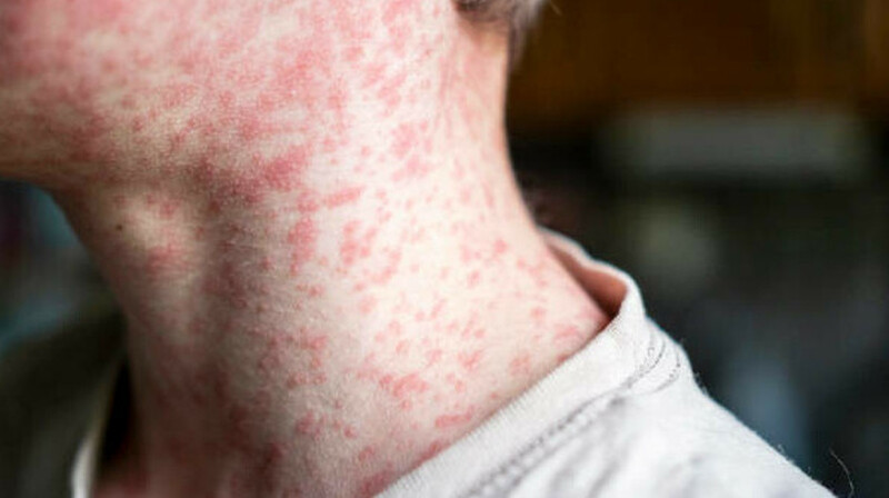 Ребенок умер от кори на фоне вспышки заболевания в США