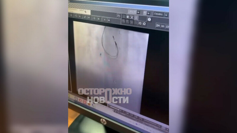 В Новосибирске врачи забыли полутораметровую струну в теле мальчика из Казахстана