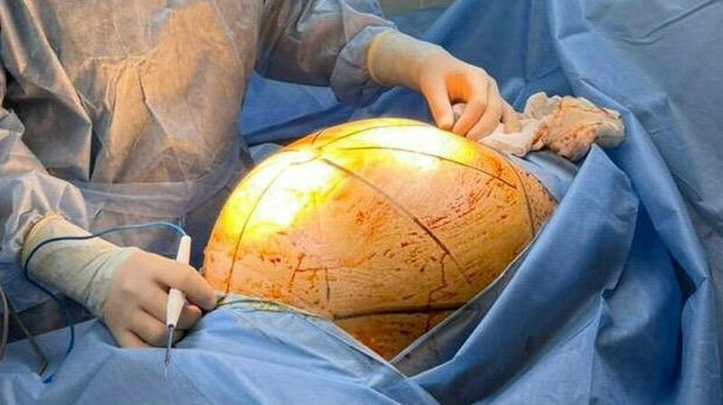 Алматинские хирурги удалили 25-килограммовую опухоль у пациентки, лечившейся БАДами